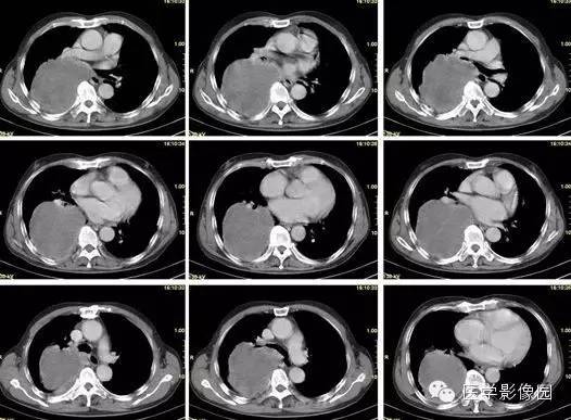 【病例】巨大中央型肺癌1例