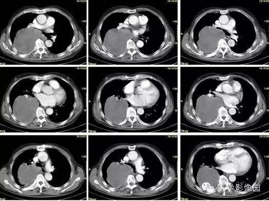 【病例】巨大中央型肺癌1例