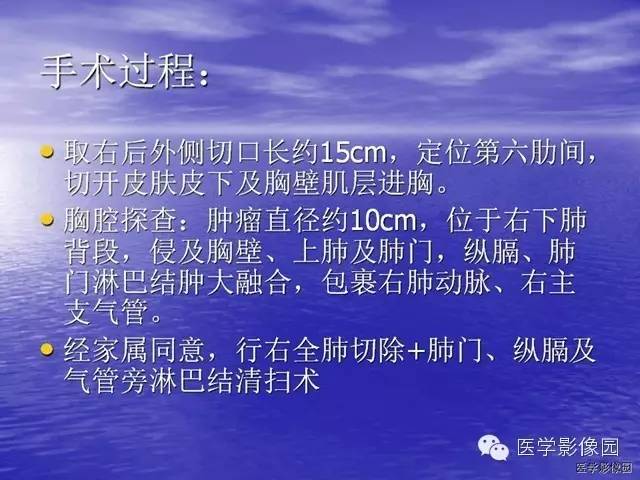 【病例】巨大中央型肺癌1例