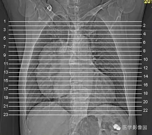 【病例】巨大中央型肺癌1例