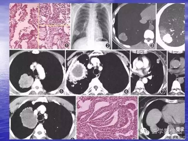 【病例】巨大中央型肺癌1例