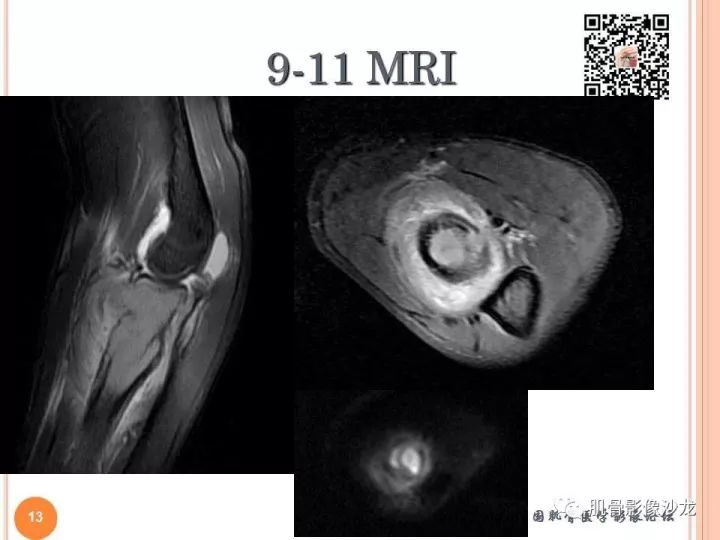 【PPT】骨与软组织Rosai-Dorfman病