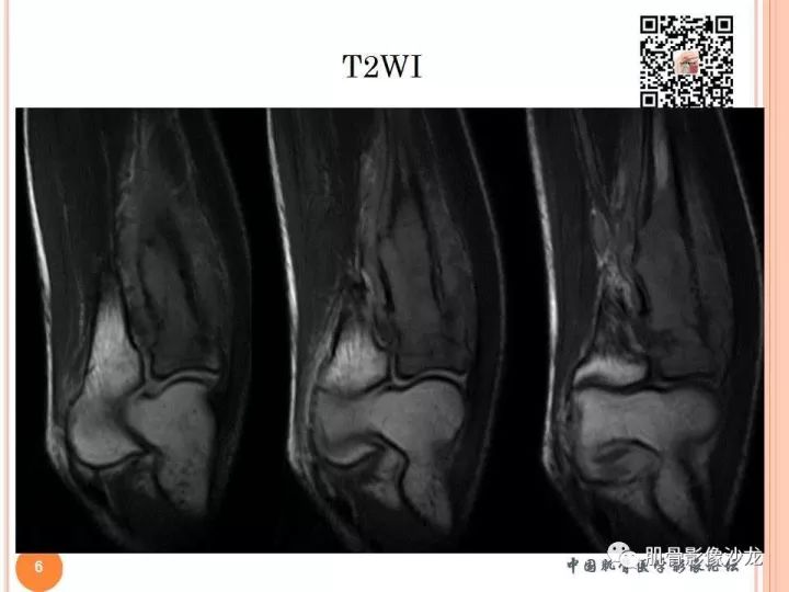 【PPT】骨与软组织Rosai-Dorfman病
