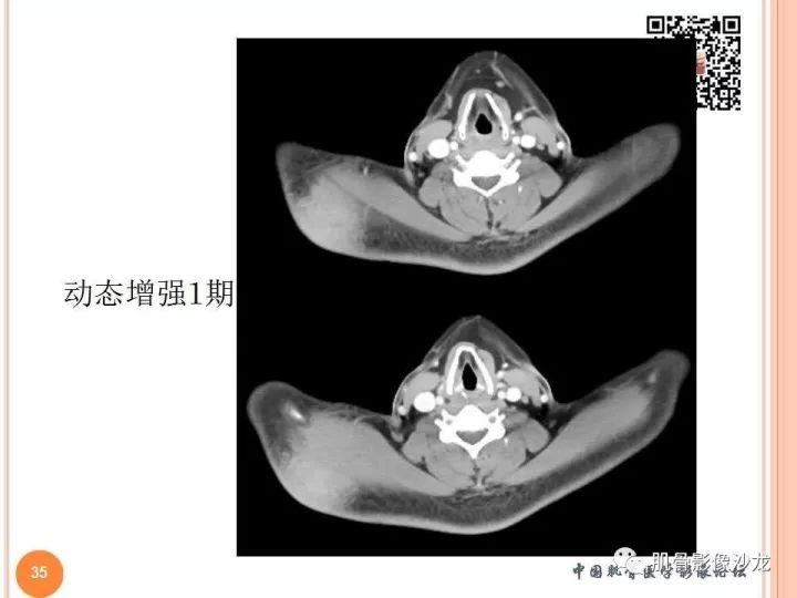 【PPT】骨与软组织Rosai-Dorfman病