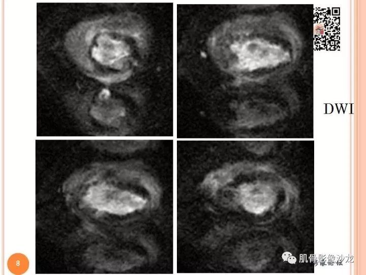 【PPT】骨与软组织Rosai-Dorfman病