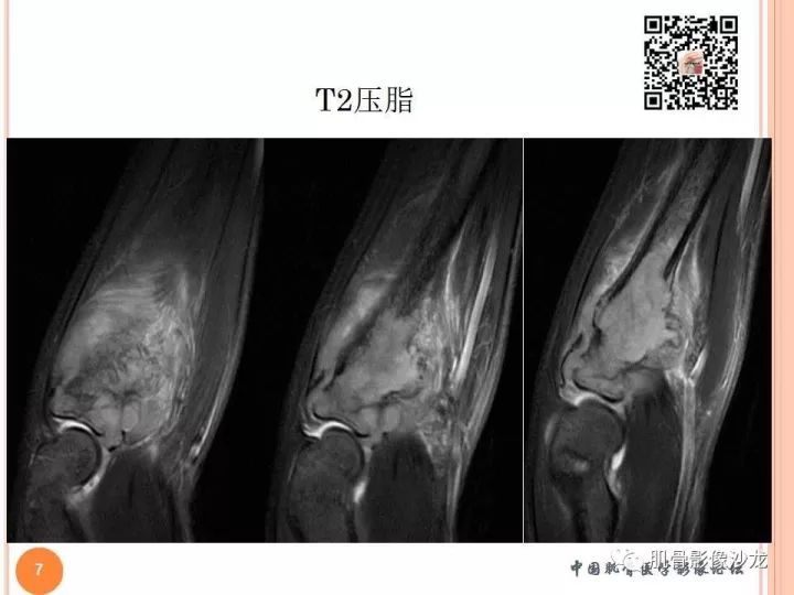 【PPT】骨与软组织Rosai-Dorfman病