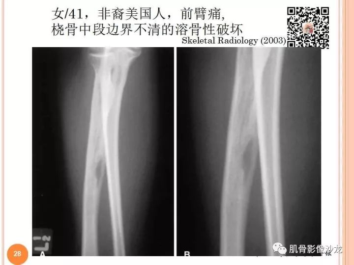【PPT】骨与软组织Rosai-Dorfman病