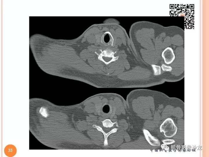 【PPT】骨与软组织Rosai-Dorfman病