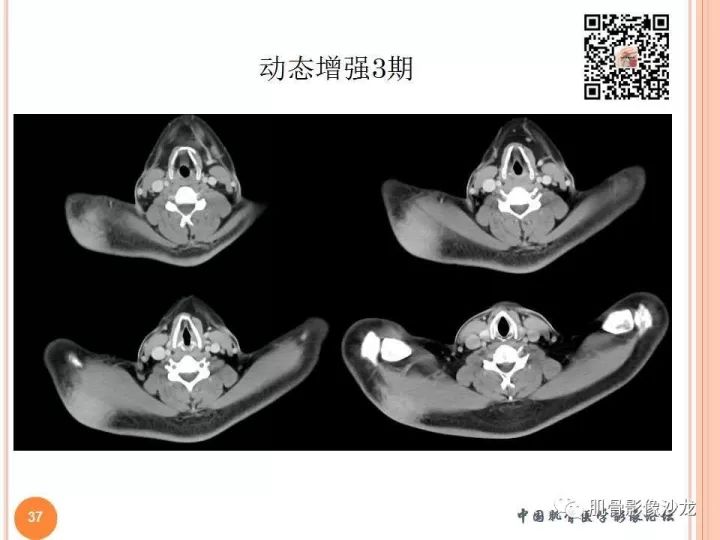 【PPT】骨与软组织Rosai-Dorfman病