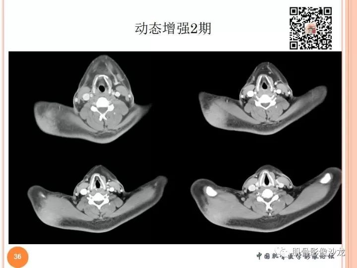 【PPT】骨与软组织Rosai-Dorfman病