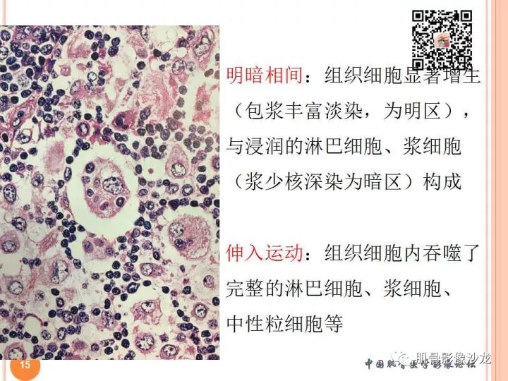 【PPT】骨与软组织Rosai-Dorfman病