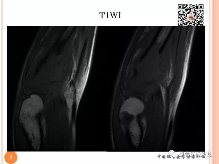 【PPT】骨与软组织Rosai-Dorfman病