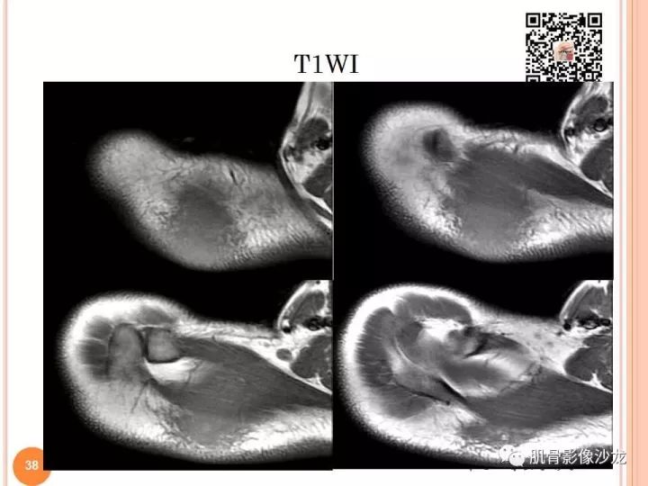 【PPT】骨与软组织Rosai-Dorfman病