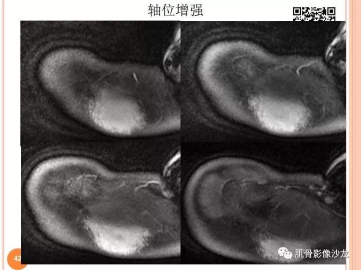 【PPT】骨与软组织Rosai-Dorfman病
