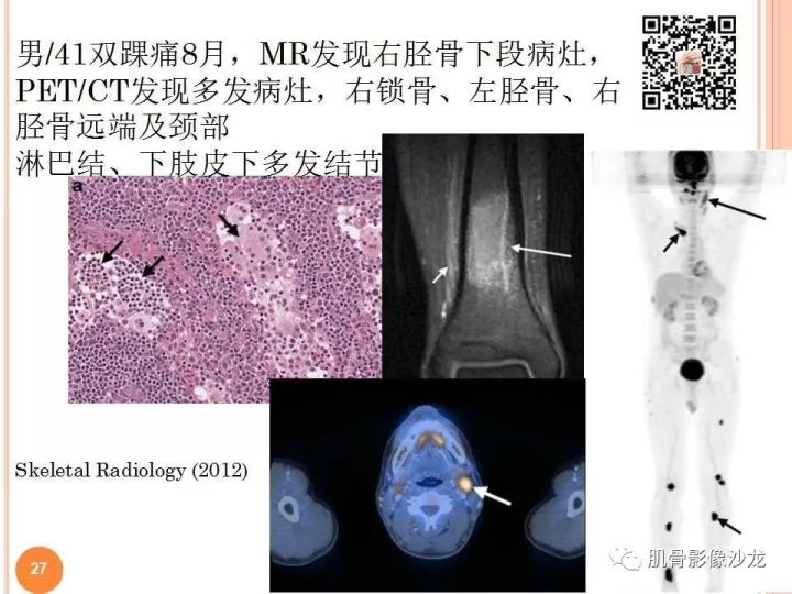 【PPT】骨与软组织Rosai-Dorfman病