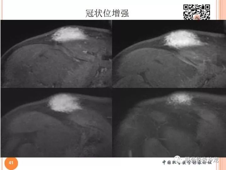 【PPT】骨与软组织Rosai-Dorfman病