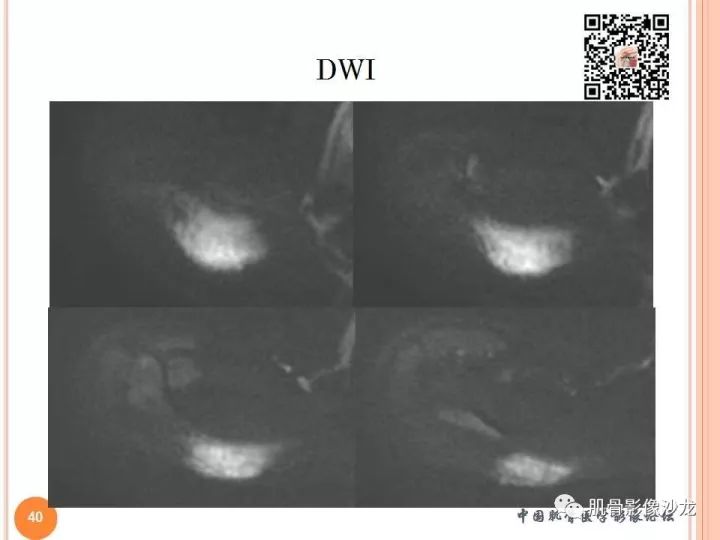 【PPT】骨与软组织Rosai-Dorfman病