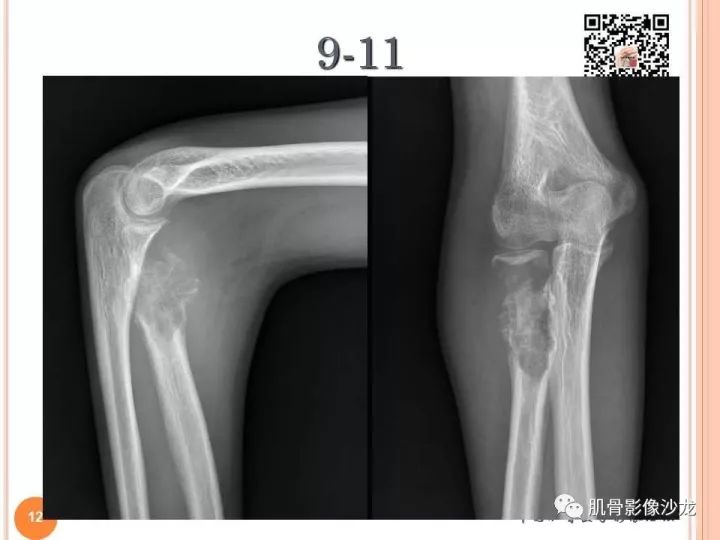 【PPT】骨与软组织Rosai-Dorfman病