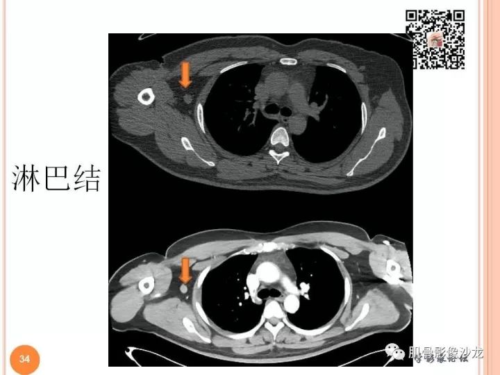 【PPT】骨与软组织Rosai-Dorfman病