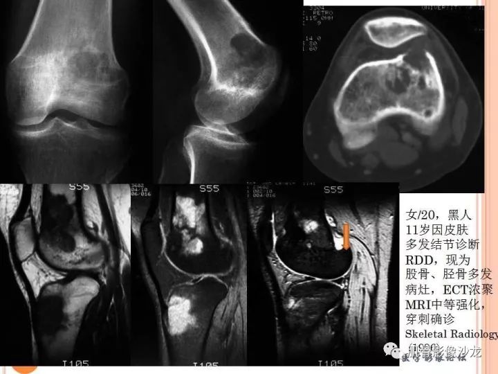 【PPT】骨与软组织Rosai-Dorfman病