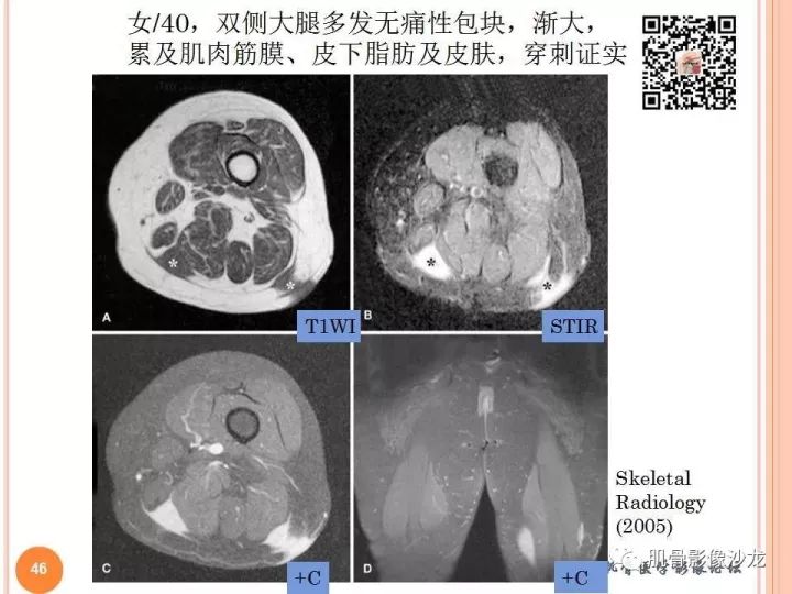 【PPT】骨与软组织Rosai-Dorfman病