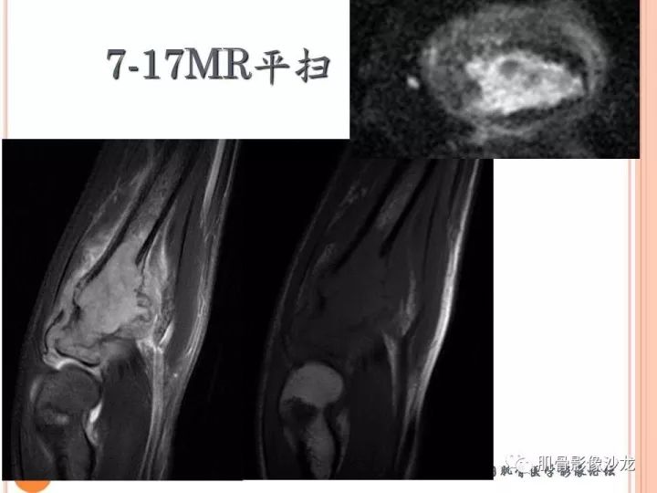 【PPT】骨与软组织Rosai-Dorfman病