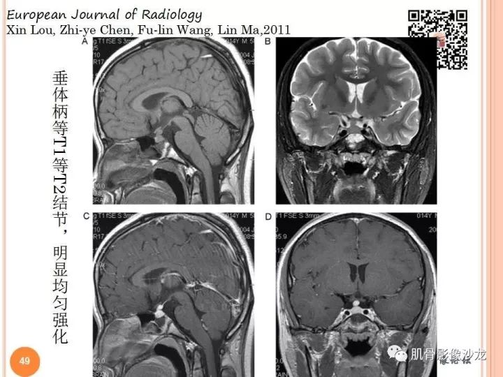 【PPT】骨与软组织Rosai-Dorfman病