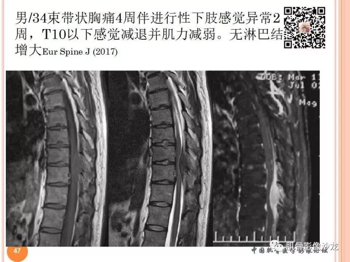 【PPT】骨与软组织Rosai-Dorfman病