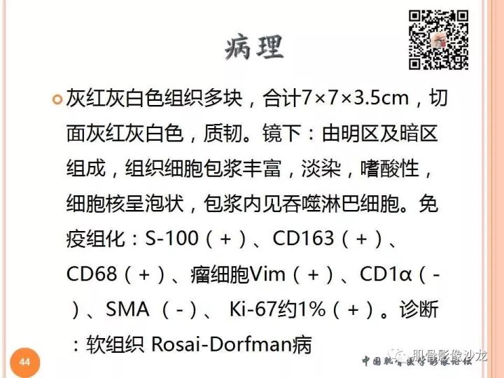 【PPT】骨与软组织Rosai-Dorfman病