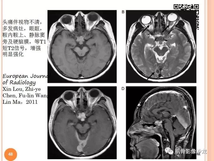 【PPT】骨与软组织Rosai-Dorfman病