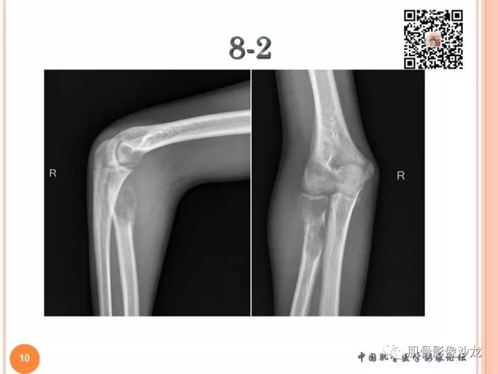 【PPT】骨与软组织Rosai-Dorfman病