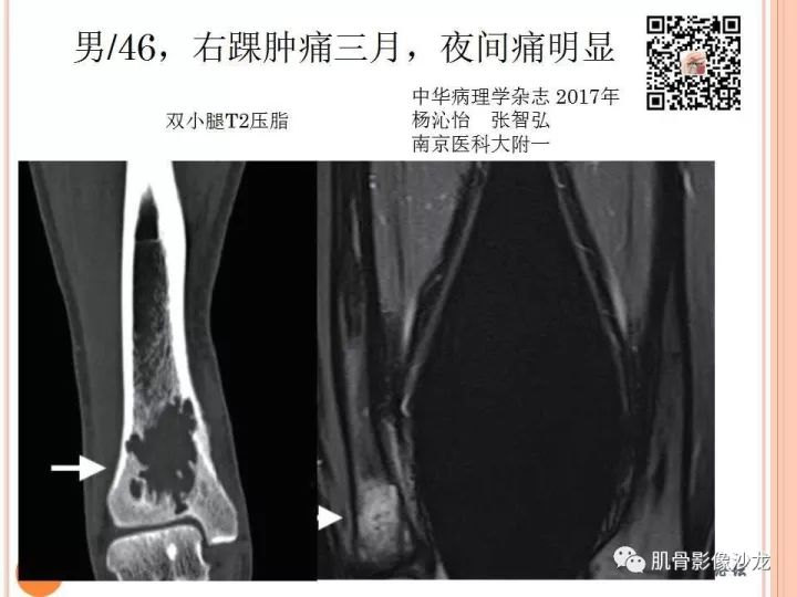 【PPT】骨与软组织Rosai-Dorfman病