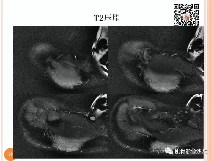 【PPT】骨与软组织Rosai-Dorfman病