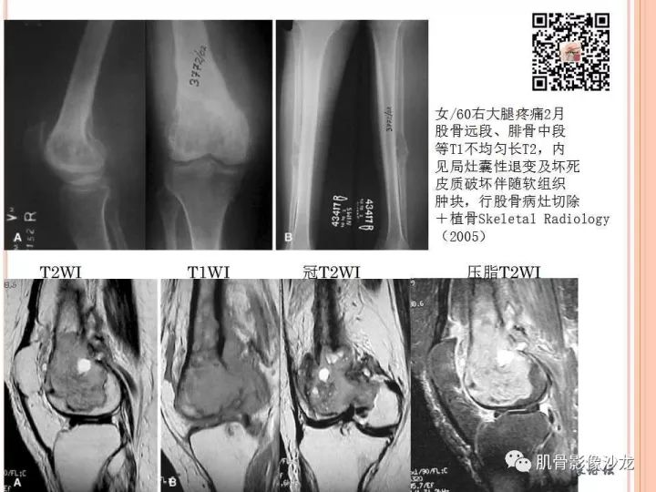 【PPT】骨与软组织Rosai-Dorfman病