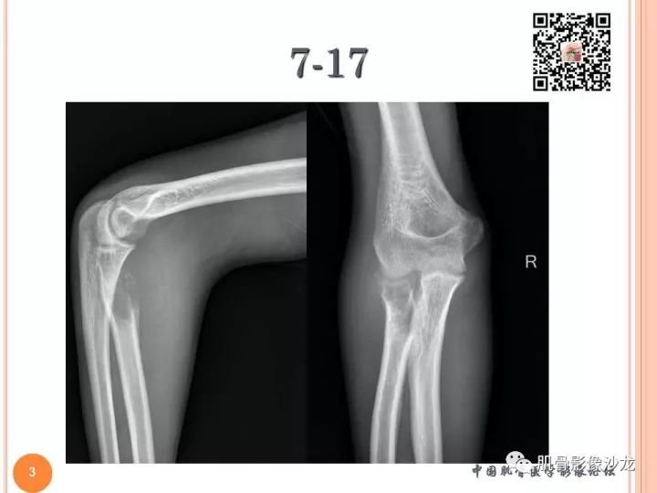 【PPT】骨与软组织Rosai-Dorfman病