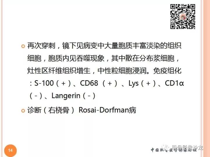 【PPT】骨与软组织Rosai-Dorfman病