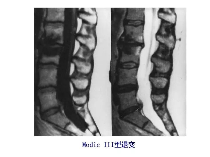 【PPT】腰椎退行性疾病影像学诊断