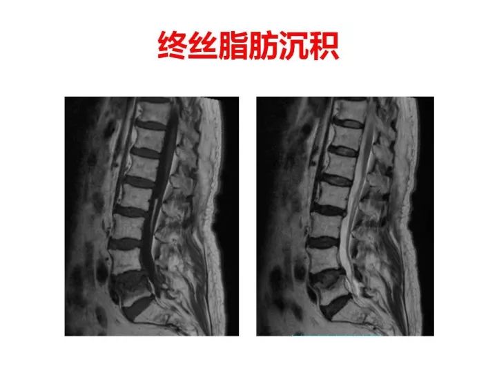【PPT】腰椎退行性疾病影像学诊断