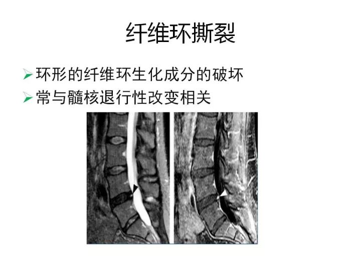 【PPT】腰椎退行性疾病影像学诊断