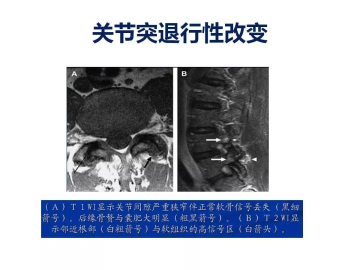 【PPT】腰椎退行性疾病影像学诊断