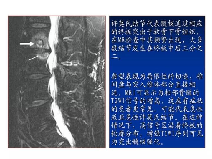 【PPT】腰椎退行性疾病影像学诊断