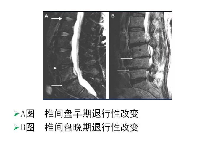 【PPT】腰椎退行性疾病影像学诊断