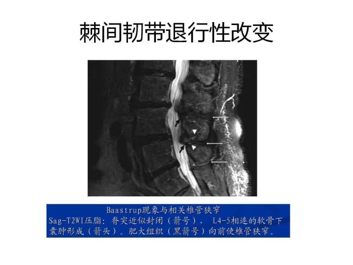 【PPT】腰椎退行性疾病影像学诊断