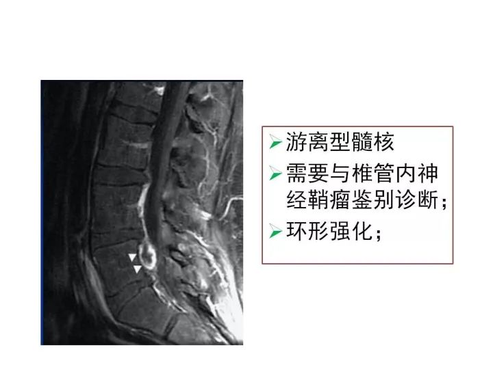 【PPT】腰椎退行性疾病影像学诊断