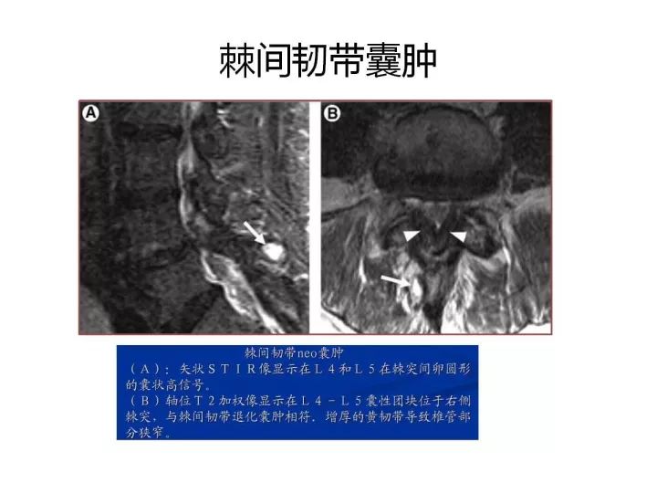 【PPT】腰椎退行性疾病影像学诊断