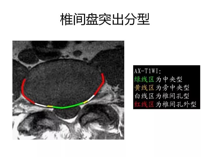 【PPT】腰椎退行性疾病影像学诊断