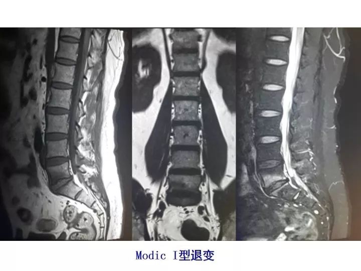 【PPT】腰椎退行性疾病影像学诊断
