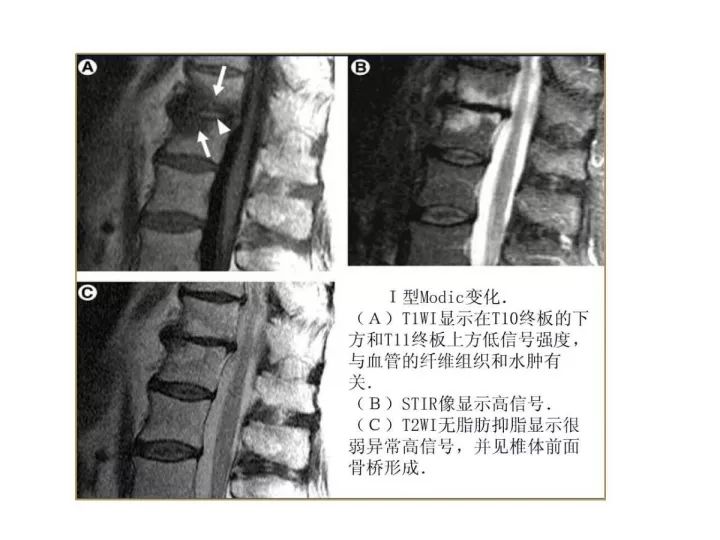 【PPT】腰椎退行性疾病影像学诊断