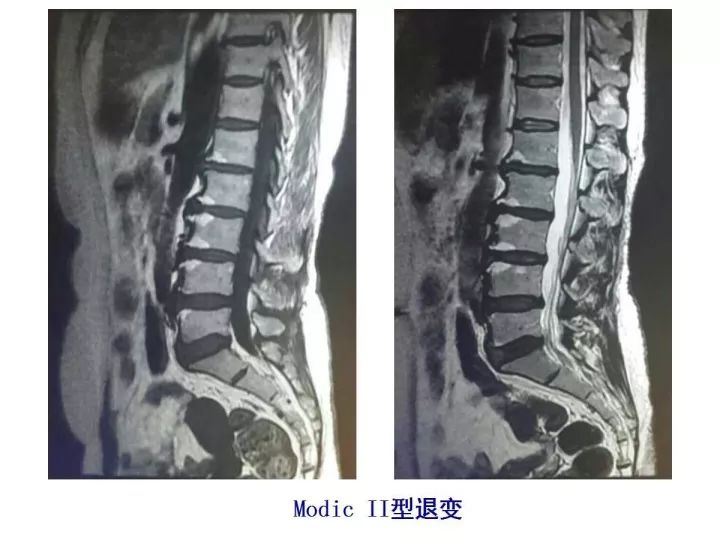【PPT】腰椎退行性疾病影像学诊断
