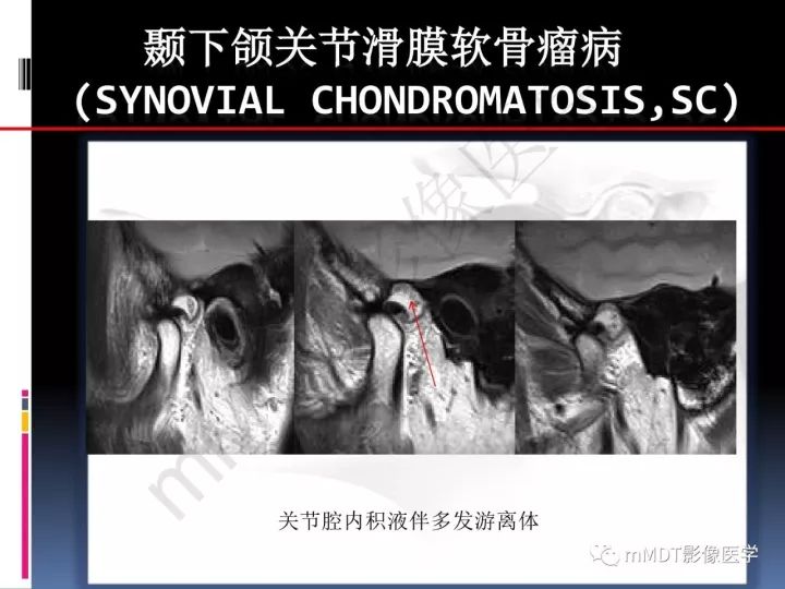 【PPT】颞下颌关节滑膜骨软骨瘤病MR分期诊断